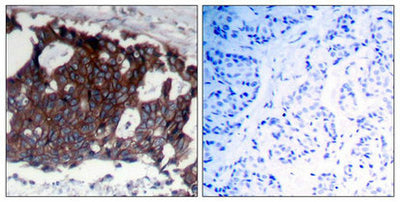 Immunohistochemical analysis of paraffin-embedded human breast carcinoma tissue using HER2(Ab-1248) Antibody(left) or the same antibody preincubated with blocking peptide(right).Rabbit anti-Human ERBB2 Polyclonal Antibody