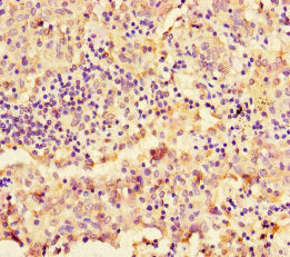 Immunohistochemistry of paraffin-embedded human lung cancer using NAPSA Antibody at dilution of 1:100Rabbit anti-Human NAPSA Polyclonal Antibody