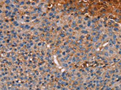 The image on the left is immunohistochemistry of paraffin-embedded Human breast cancer tissue using NOC2L Antibody(NOC2L Antibody) at dilution 1/20, on the right is treated with fusion protein. (Original magnification: ×200)Rabbit anti-Human NOC2L Polyclonal Antibody
