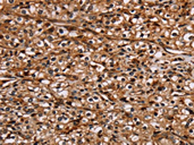 The image on the left is immunohistochemistry of paraffin-embedded Human prostate cancer tissue using the antibody Antibody) at dilution 1/20, on the right is treated with fusion protein. (Original magnification: ×200)Rabbit anti-Human NOC2L Polyclonal Antibody