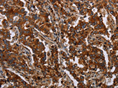 The image on the left is immunohistochemistry of paraffin-embedded Human liver cancer tissue using the antibody Antibody) at dilution 1/25, on the right is treated with synthetic peptide. (Original magnification: ×200)