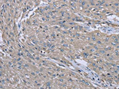 The image on the left is immunohistochemistry of paraffin-embedded Human esophagus cancer tissue using EZR Antibody(EZR Antibody) at dilution 1/30, on the right is treated with fusion protein. (Original magnification: ×200)Rabbit anti-Human EZR Polyclonal Antibody