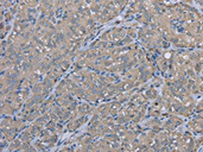 The image on the left is immunohistochemistry of paraffin-embedded Human thyroid cancer tissue using the antibody Antibody) at dilution 1/30, on the right is treated with fusion protein. (Original magnification: ×200)Rabbit anti-Human EZR Polyclonal Antibody