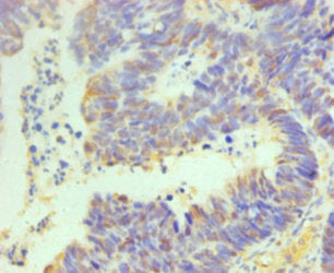 Immunohistochemistry of paraffin-embedded human ovarian cancer using POU5F1 Antibody at dilution of 1:100Rabbit anti-Human POU5F1 Polyclonal Antibody