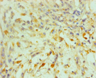 Immunohistochemistry of paraffin-embedded human melanoma using POU5F1 Antibody at dilution of 1:100Rabbit anti-Human POU5F1 Polyclonal Antibody
