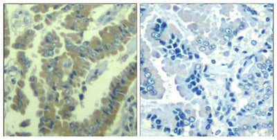Immunohistochemical analysis of paraffin-embedded human lung carcinoma tissue using MARCKS(Phospho-Ser170) Antibody(left) or the same antibody preincubated with blocking peptide(right).