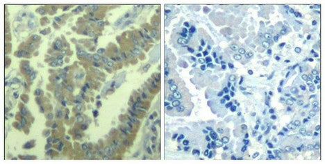 Immunohistochemical analysis of paraffin-embedded human lung carcinoma tissue using MARCKS(Phospho-Ser170) Antibody(left) or the same antibody preincubated with blocking peptide(right).