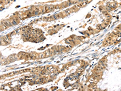The image on the left is immunohistochemistry of paraffin-embedded Human esophagus cancer tissue using PSMB8 Antibody(PSMB8 Antibody) at dilution 1/30, on the right is treated with synthetic peptide. (Original magnification: ×200)Rabbit anti-Human PSMB8 Polyclonal Antibody