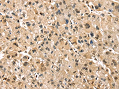 The image on the left is immunohistochemistry of paraffin-embedded Human liver cancer tissue using the antibody Antibody) at dilution 1/30, on the right is treated with synthetic peptide. (Original magnification: ×200)Rabbit anti-Human PSMB8 Polyclonal Antibody