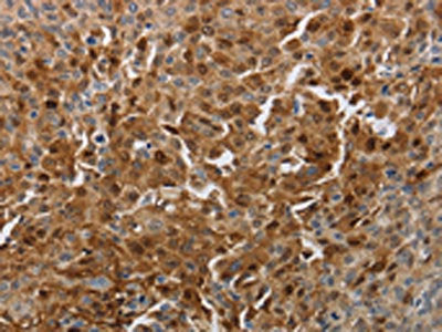 The image on the left is immunohistochemistry of paraffin-embedded Human cervical cancer tissue using PDCD2 Antibody(PDCD2 Antibody) at dilution 1/10, on the right is treated with synthetic peptide. (Original magnification: ×200)Rabbit anti-Human PDCD2 Polyclonal Antibody