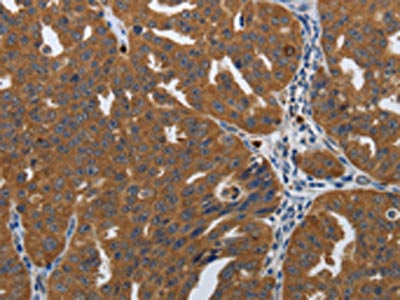 The image on the left is immunohistochemistry of paraffin-embedded Human ovarian cancer tissue using the antibody Antibody) at dilution 1/10, on the right is treated with synthetic peptide. (Original magnification: ×200)Rabbit anti-Human PDCD2 Polyclonal Antibody
