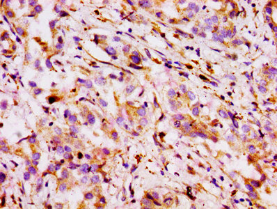 Immunohistochemistry of paraffin-embedded human liver cancer using ABCB1 Antibody at dilution of 1:100