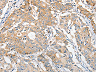 The image on the left is immunohistochemistry of paraffin-embedded Human gastric cancer tissue using APOBEC3G Antibody(APOBEC3G Antibody) at dilution 1/30, on the right is treated with fusion protein. (Original magnification: ×200)Rabbit anti-Human APOBEC3G Polyclonal Antibody