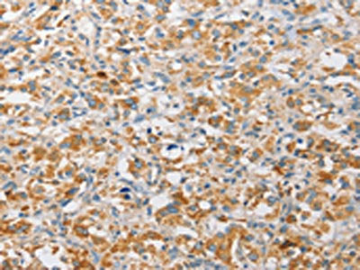 The image on the left is immunohistochemistry of paraffin-embedded Human thyroid cancer tissue using the antibody Antibody) at dilution 1/30, on the right is treated with fusion protein. (Original magnification: ×200)Rabbit anti-Human APOBEC3G Polyclonal Antibody