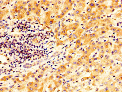 IHC image of TGM2 Antibody diluted at 1:400 and staining in paraffin-embedded human liver cancer performed on a Leica BondTM system. After dewaxing and hydration, antigen retrieval was mediated by high pressure in a citrate buffer (pH 6.0). Section was blocked with 10% normal goat serum 30min at RT. Then primary antibody (1% BSA) was incubated at 4°C overnight. The primary is detected by a biotinylated secondary antibody and visualized using an HRP conjugated SP system.Rabbit anti-Human TGM2 Polyclonal Antibody