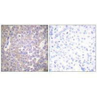 Immunohistochemical analysis of paraffin-embedded human breast carcinoma tissue using Claudin 2 antibody.Rabbit anti-Human CLDN2 Polyclonal Antibody