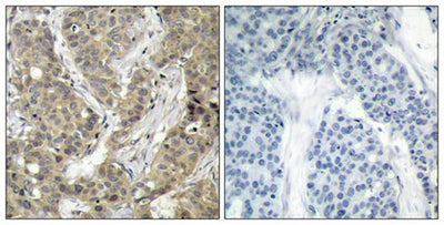 Immunohistochemical analysis of paraffin-embedded human breast carcinoma tissue using b-Catenin(Ab-37) Antibody(left) or the same antibody preincubated with blocking peptide(right).Rabbit anti-Human CTNNB1 Polyclonal Antibody