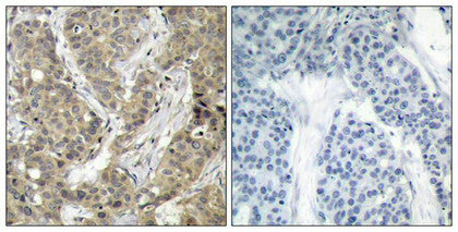 Immunohistochemical analysis of paraffin-embedded human breast carcinoma tissue using b-Catenin(Ab-37) Antibody(left) or the same antibody preincubated with blocking peptide(right).Rabbit anti-Human CTNNB1 Polyclonal Antibody