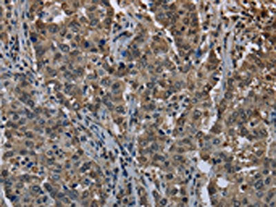 The image on the left is immunohistochemistry of paraffin-embedded Human liver cancer tissue using UBB Antibody(UBB Antibody) at dilution 1/20, on the right is treated with fusion protein. (Original magnification: ×200)Rabbit anti-Human UBB Polyclonal Antibody