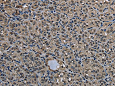 The image on the left is immunohistochemistry of paraffin-embedded Human thyroid cancer tissue using the antibody Antibody) at dilution 1/20, on the right is treated with fusion protein. (Original magnification: ×200)Rabbit anti-Human UBB Polyclonal Antibody