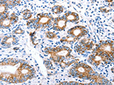 The image on the left is immunohistochemistry of paraffin-embedded Human stomach cancer tissue using CLDN7 Antibody(CLDN7 Antibody) at dilution 1/50, on the right is treated with synthetic peptide. (Original magnification: ×200)Rabbit anti-Human CLDN7 Polyclonal Antibody