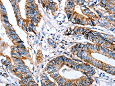 The image on the left is immunohistochemistry of paraffin-embedded Human colon cancer tissue using the antibody Antibody) at dilution 1/50, on the right is treated with synthetic peptide. (Original magnification: ×200)Rabbit anti-Human CLDN7 Polyclonal Antibody