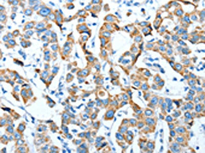 The image on the left is immunohistochemistry of paraffin-embedded Human breast cancer tissue using TNNI3 Antibody(TNNI3 Antibody) at dilution 1/20, on the right is treated with fusion protein. (Original magnification: ×200)Rabbit anti-Human TNNI3 Polyclonal Antibody