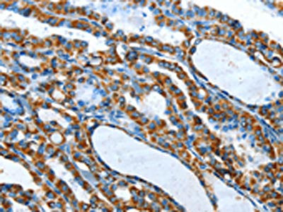 The image on the left is immunohistochemistry of paraffin-embedded Human thyroid cancer tissue using the antibody Antibody) at dilution 1/20, on the right is treated with fusion protein. (Original magnification: ×200)Rabbit anti-Human TNNI3 Polyclonal Antibody