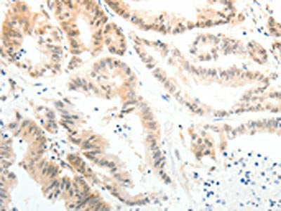 The image on the left is immunohistochemistry of paraffin-embedded Human colon cancer tissue using ABL2 Antibody(ABL2 Antibody) at dilution 1/25, on the right is treated with synthetic peptide. (Original magnification: ×200)