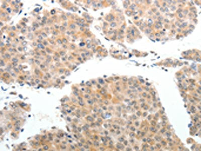 The image on the left is immunohistochemistry of paraffin-embedded Human liver cancer tissue using the antibody Antibody) at dilution 1/25, on the right is treated with synthetic peptide. (Original magnification: ×200)