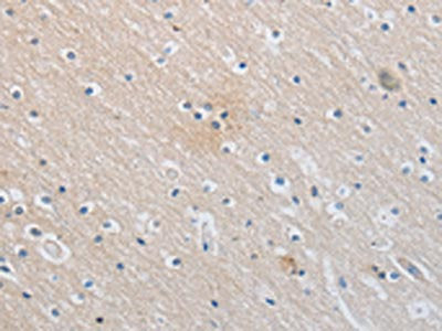 The image on the left is immunohistochemistry of paraffin-embedded Human brain  tissue using SLC16A7 Antibody(SLC16A7 Antibody) at dilution 1/30, on the right is treated with synthetic peptide. (Original magnification: ×200)Rabbit anti-Human SLC16A7 Polyclonal Antibody
