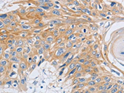 The image on the left is immunohistochemistry of paraffin-embedded Human esophagus cancer tissue using the antibody Antibody) at dilution 1/30, on the right is treated with synthetic peptide. (Original magnification: ×200)Rabbit anti-Human SLC16A7 Polyclonal Antibody