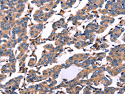 The image on the left is immunohistochemistry of paraffin-embedded Human breast cancer tissue using RDX Antibody(RDX Antibody) at dilution 1/60, on the right is treated with fusion protein. (Original magnification: ×200)Rabbit anti-Human RDX Polyclonal Antibody
