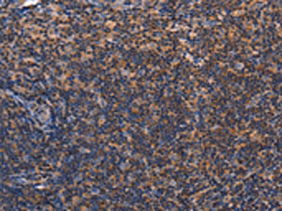 The image on the left is immunohistochemistry of paraffin-embedded Human tonsil tissue using the antibody Antibody) at dilution 1/60, on the right is treated with fusion protein. (Original magnification: ×200)Rabbit anti-Human RDX Polyclonal Antibody