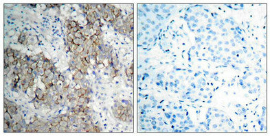 Immunohistochemical analysis of paraffin- embedded human breast carcinoma tissue using IGF-1R (phospho-Tyr1161) antibody.Rabbit anti-Human IGF1R Polyclonal Antibody