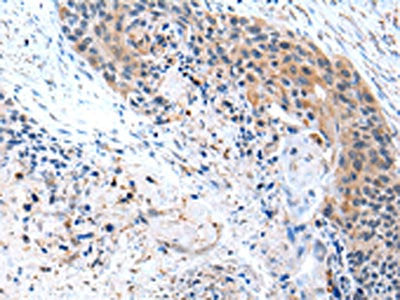 The image on the left is immunohistochemistry of paraffin-embedded Human esophagus cancer tissue using CFC1 Antibody(CFC1 Antibody) at dilution 1/20, on the right is treated with synthetic peptide. (Original magnification: ×200)Rabbit anti-Human CFC1 Polyclonal Antibody