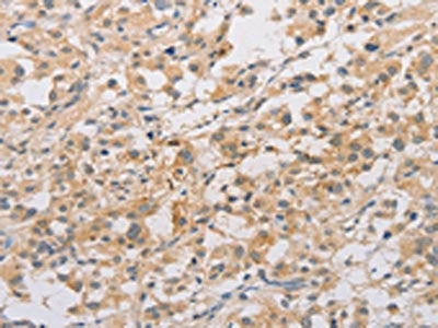 The image on the left is immunohistochemistry of paraffin-embedded Human thyroid cancer tissue using ARSF Antibody(ARSF Antibody) at dilution 1/20, on the right is treated with fusion protein. (Original magnification: ×200)Rabbit anti-Human ARSF Polyclonal Antibody