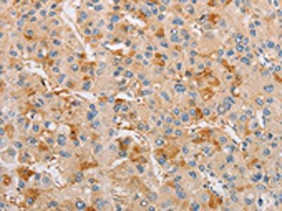 The image on the left is immunohistochemistry of paraffin-embedded Human liver cancer tissue using the antibody Antibody) at dilution 1/20, on the right is treated with fusion protein. (Original magnification: ×200)Rabbit anti-Human ARSF Polyclonal Antibody