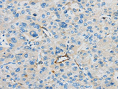 The image on the left is immunohistochemistry of paraffin-embedded Human liver cancer tissue using the antibody Antibody) at dilution 1/35, on the right is treated with synthetic peptide. (Original magnification: ×200)Rabbit anti-Human CD63 Polyclonal Antibody