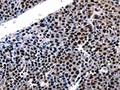 The image on the left is immunohistochemistry of paraffin-embedded Human liver cancer tissue using HDAC1 Antibody(HDAC1 Antibody) at dilution 1/5, on the right is treated with fusion protein. (Original magnification: ×200)Rabbit anti-Human HDAC1 Polyclonal Antibody