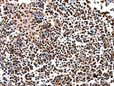 The image on the left is immunohistochemistry of paraffin-embedded Human tonsil tissue using the antibody Antibody) at dilution 1/5, on the right is treated with fusion protein. (Original magnification: ×200)Rabbit anti-Human HDAC1 Polyclonal Antibody