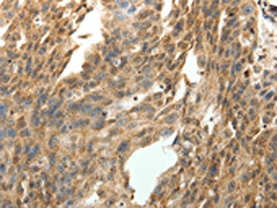 The image on the left is immunohistochemistry of paraffin-embedded Human ovarian cancer tissue using SYT7 Antibody(SYT7 Antibody) at dilution 1/15, on the right is treated with fusion protein. (Original magnification: ×200)Rabbit anti-Human SYT7 Polyclonal Antibody