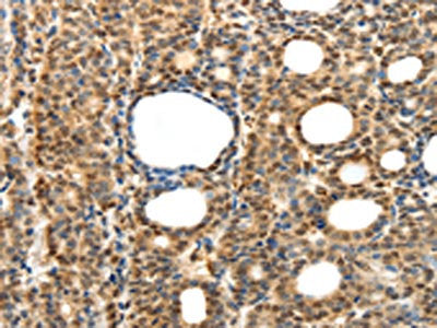 The image on the left is immunohistochemistry of paraffin-embedded Human thyroid cancer tissue using the antibody Antibody) at dilution 1/15, on the right is treated with fusion protein. (Original magnification: ×200)Rabbit anti-Human SYT7 Polyclonal Antibody