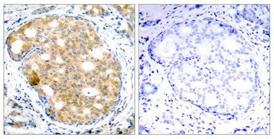 Immunohistochemical analysis of paraffin-embedded human breast carcinoma tissue using GSK3b(Ab-9) Antibody(left) or the same antibody preincubated with blocking peptide(right).Rabbit anti-Human GSK3B Polyclonal Antibody