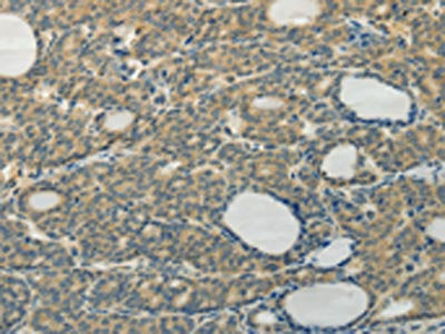 The image on the left is immunohistochemistry of paraffin-embedded Human thyroid cancer tissue using TAGLN2 Antibody(TAGLN2 Antibody) at dilution 1/40, on the right is treated with fusion protein. (Original magnification: ×200)Rabbit anti-Human TAGLN2 Polyclonal Antibody