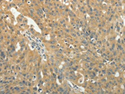 The image on the left is immunohistochemistry of paraffin-embedded Human ovarian cancer tissue using the antibody Antibody) at dilution 1/40, on the right is treated with fusion protein. (Original magnification: ×200)Rabbit anti-Human TAGLN2 Polyclonal Antibody