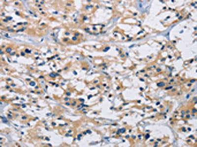 The image on the left is immunohistochemistry of paraffin-embedded Human thyroid cancer tissue using IL17RB Antibody(IL17RB Antibody) at dilution 1/40, on the right is treated with synthetic peptide. (Original magnification: ×200)