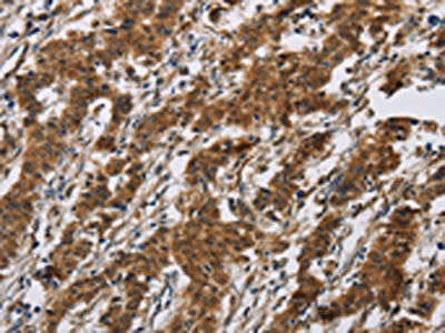 The image on the left is immunohistochemistry of paraffin-embedded Human gastic cancer tissue using the antibody Antibody) at dilution 1/40, on the right is treated with synthetic peptide. (Original magnification: ×200)
