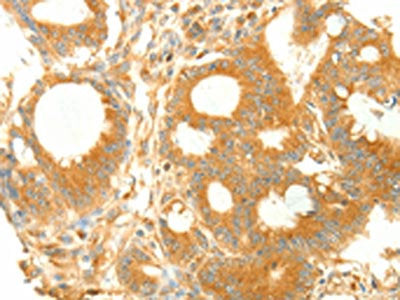 The image on the left is immunohistochemistry of paraffin-embedded Human colon cancer tissue using NAPA Antibody(NAPA Antibody) at dilution 1/25, on the right is treated with fusion protein. (Original magnification: ×200)Rabbit anti-Human NAPA Polyclonal Antibody