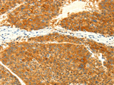 The image on the left is immunohistochemistry of paraffin-embedded Human liver cancer tissue using the antibody Antibody) at dilution 1/25, on the right is treated with fusion protein. (Original magnification: ×200)Rabbit anti-Human NAPA Polyclonal Antibody